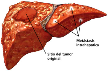 Que es cancer higado, Cancer pulmonar metastasis higado
