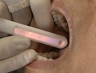 Cáncer de Orofaringe y Cavidad Oral