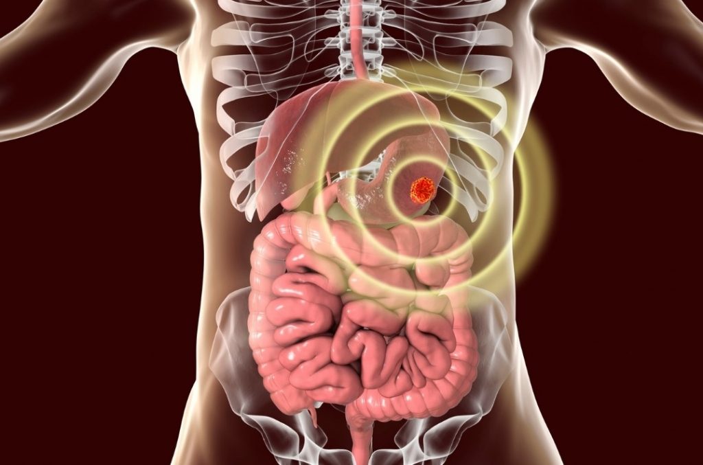 Existen signos y síntomas que pueden estar relacionados al cáncer de estómago