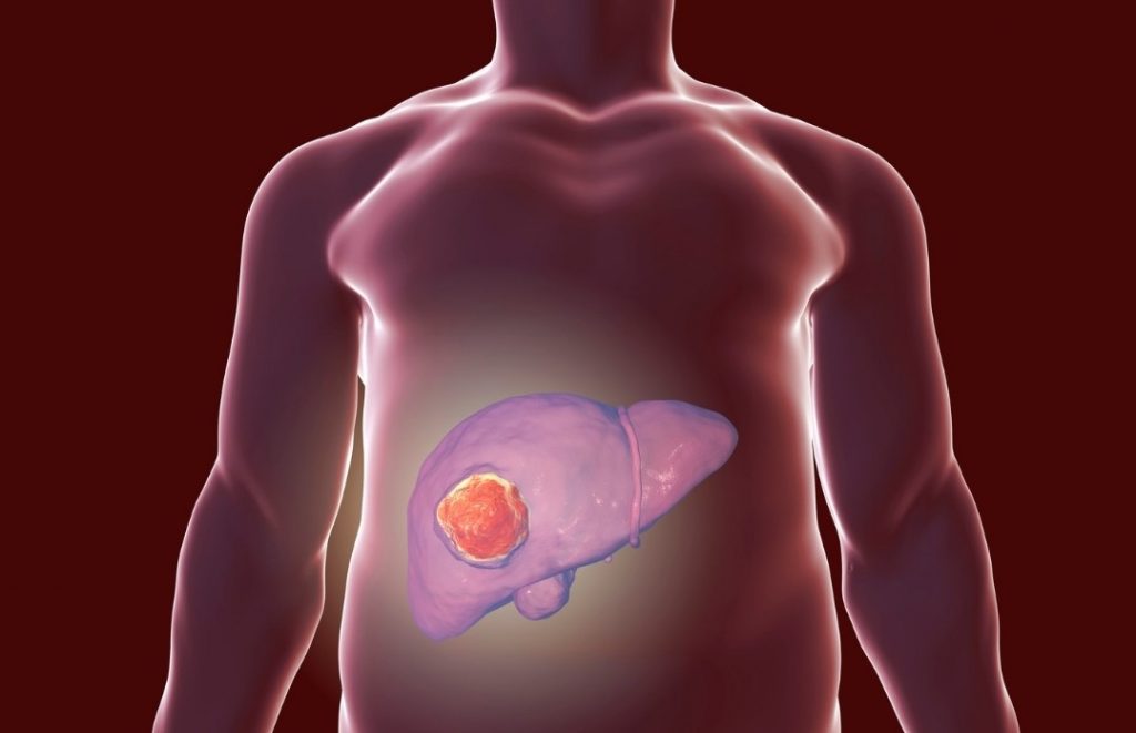 Cáncer de hígado: Conoce los síntomas y la forma de prevenirlo