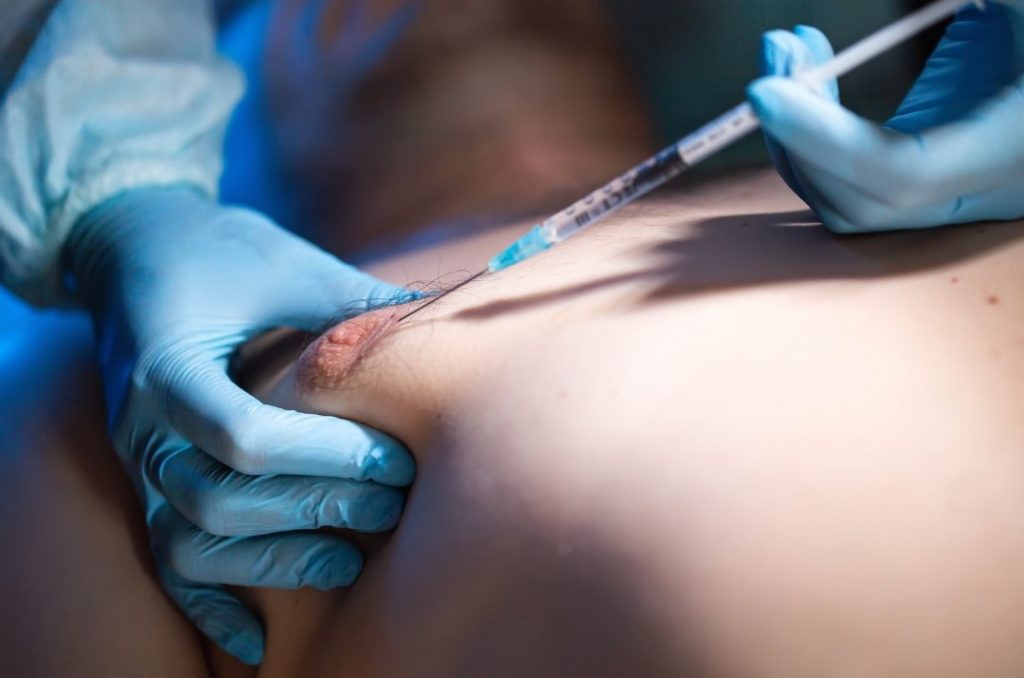 Cáncer de mama en varones se diagnostica generalmente en estadíos avanzados