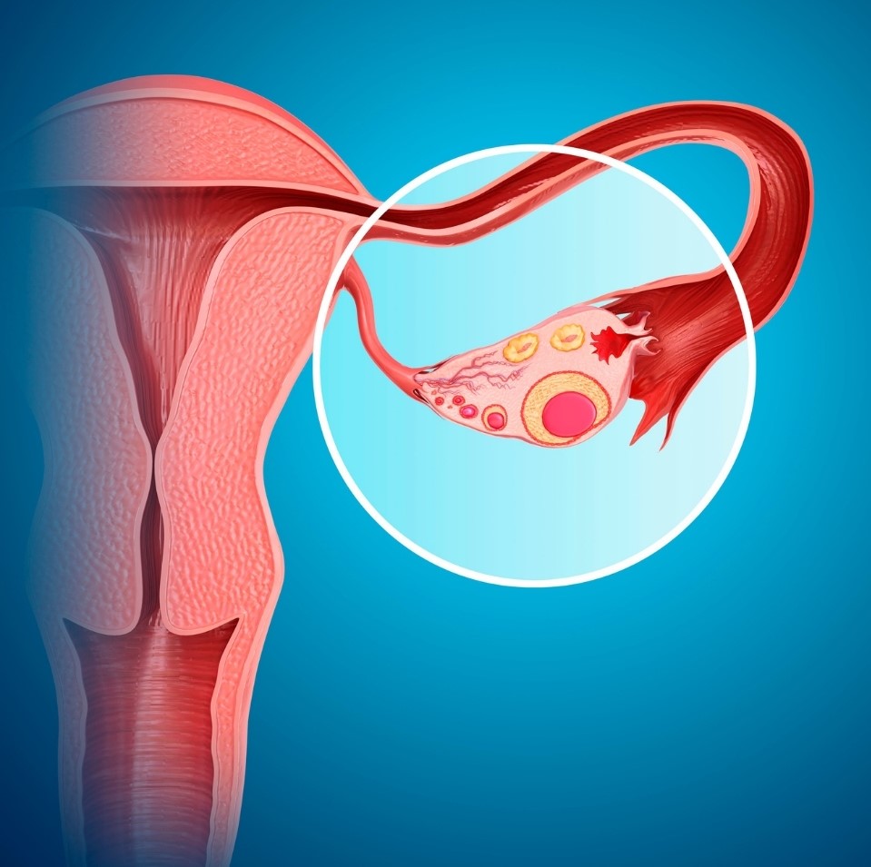 Cáncer de ovario es más común en mujeres de 55 a 65 años