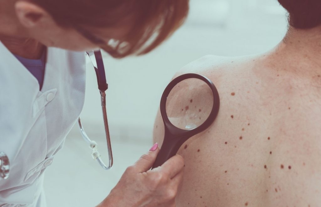 Riesgo de cáncer de piel en los peruanos debido a mayores niveles de radiación ultravioleta